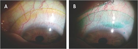 Figure 1. Comparison between the use of fluorescein (A) and lissamine green (B) for the assessment of the lens alignment on the sclera. The use of lissamine green allows a better evaluation because its green color has a higher contrast with the white sclera. Additionally, the images show a sectorial lens edge lifting off with a moderate tear influx into the liquid reservoir. The lens lifting off in the vertical meridian denotes a with-the-rule scleral toricity.