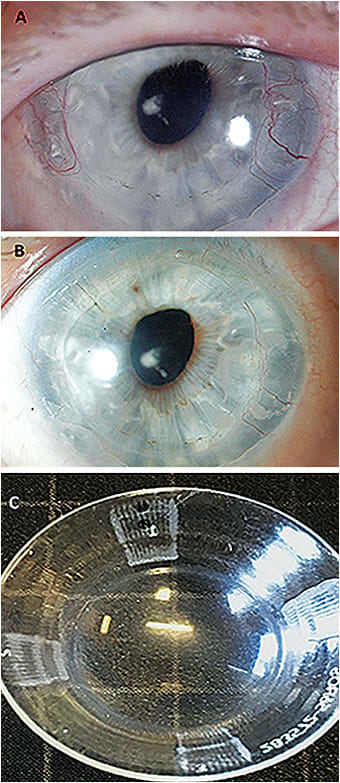 Figure 5. Increased neovascularization and edema along the graft-host junction in a post-PK cornea secondary to Fuchs’ dystrophy (A). The material was Boston XO2 (Dk 141) (Bausch + Lomb) with CT of 250μm at the time. Edema and neovascularization resolved after adding channels under the haptic surface at 3 o’clock and 9 o’clock to prevent/minimize suction (B). An example of channels added in four meridians—such as the ones added in the case above and in similar cases to promote tear exchange and minimize/prevent suction (C).
Image courtesy of Karen G. Carrasquillo, OD, PhD