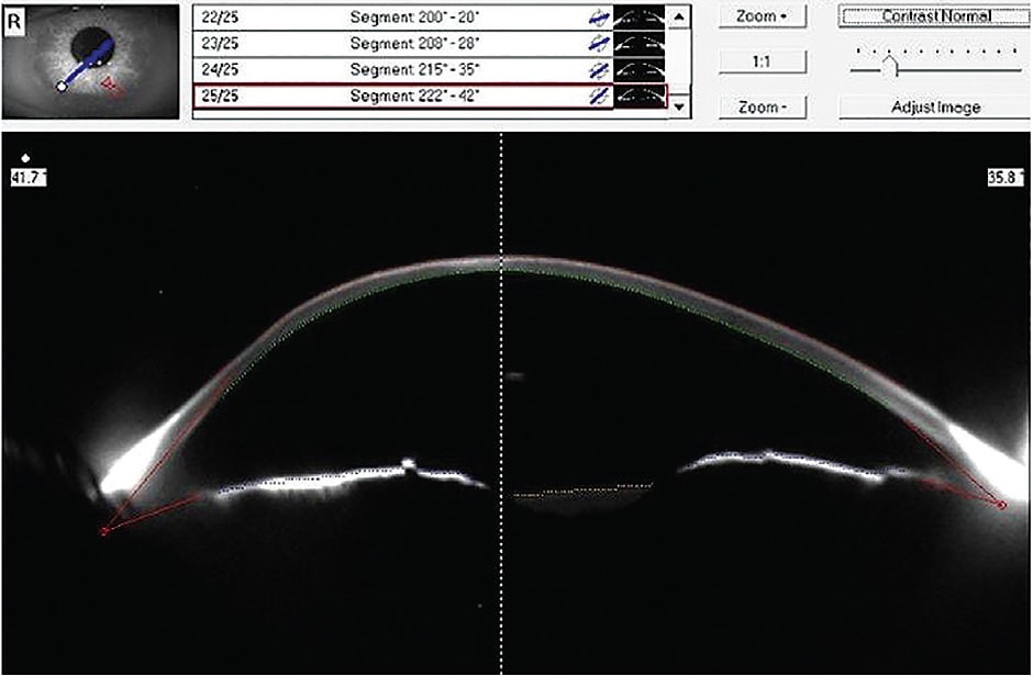 Figure 2. Scheimpflug image showing corneal thinning near limbus (left side).