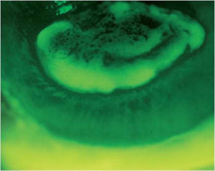 Figure 7. Microcystic epithelial edema (MCE) as seen by the presence of negative staining when stained with sodium fluorescein.
Image courtesy of Karen G. Carrasquillo, OD, PhD