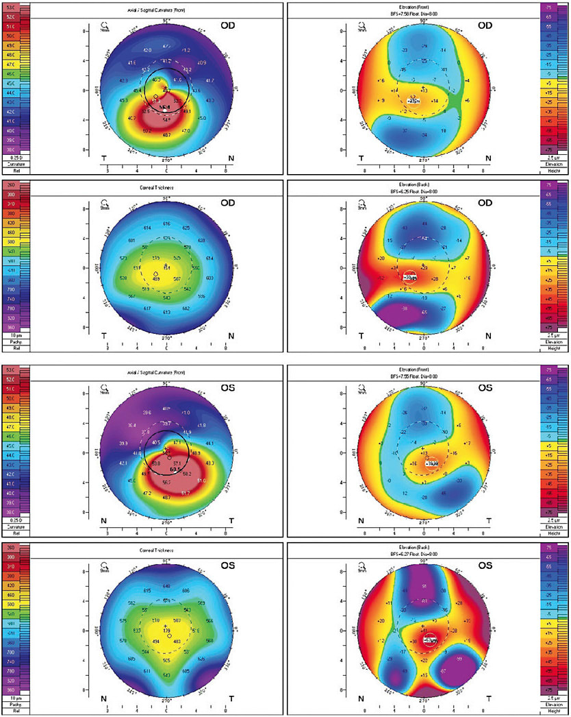 Figure 1. Pentacam images of the right and left eyes, showing inferior corneal steepening and thinning.