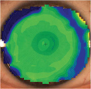 Figure 3. A topography measurement over a center-near custom soft lens.