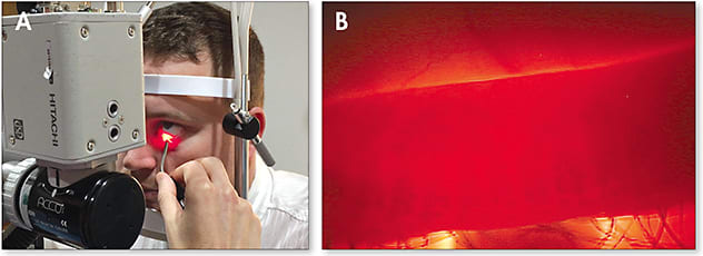 Figure 2. Eyelid transillumination being performed at the slit lamp (A). Slit lamp view of eyelid transillumination for visualization of the meibomian glands (B).