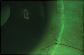 Figure 6. Conjunctival tissue stained with fluorescein corresponding to lens edge impingement.
