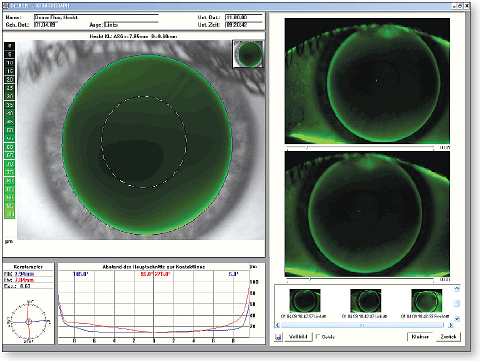 Figure 4. Contact lens fitting software demonstrating a simulated fluorescein pattern on the left, the actual static fluorescein pattern on the upper right, and the actual dynamic video fluorescein pattern on the lower right.