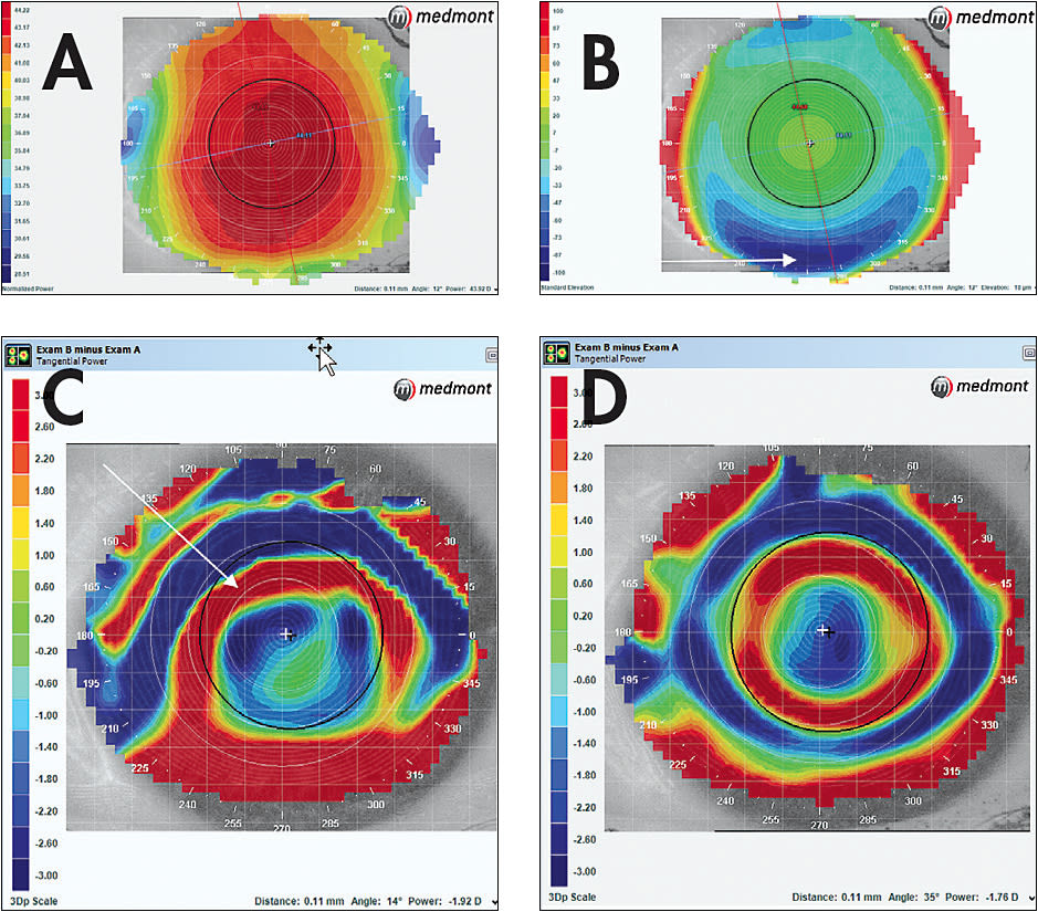 Figure 10. (A) A clinically spherical cornea. (B) More elevation difference, 21.5 microns, than may be expected at the 8.00mm chord, where the alignment curve contacts the cornea. (C and D) The comparison of the effect of elevation on one night of lens wear in which the meridian-specific lens (D) shows better centration of treatment. This effect of decentration is more obvious when viewing the tangential subtractive maps in (C), in which the spherical lens is inferiorly decentered as indicated by the “frowny face” pattern.