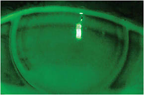 Figure 2. Bitoric GP on the same eye.