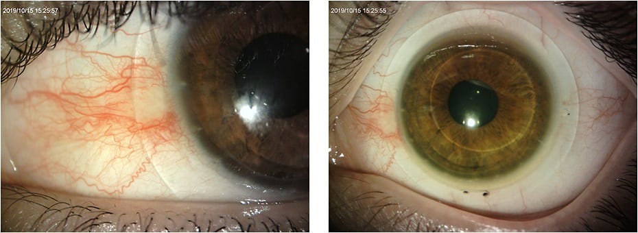 Figure 2. Trial lens 1 OS revealing haptic alignment with toric periphery and nasal vault.