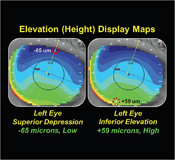Figure 1. Elevation display showing a 124-micron height differential.