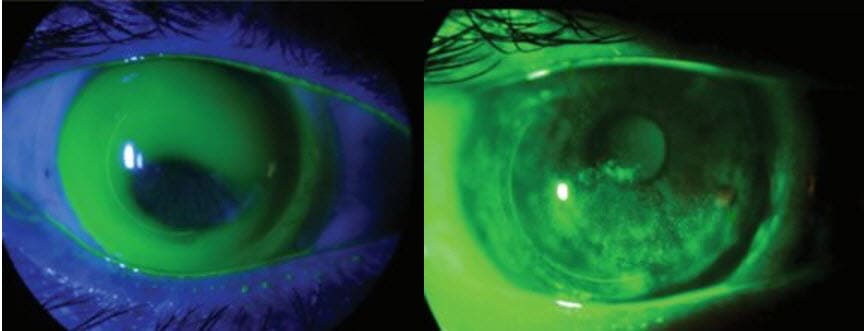 Figure 1. Various customized in-office pamphlets covering a variety of contact lens topics.