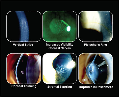 Figure 2. Common slit lamp findings in keratoconus.