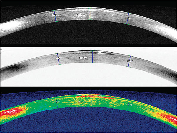 Figure 3. AS-OCT images of the patient’s left eye vertical (180º) meridian.