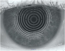 Figure 1. Look for distorted mires, areas where the mires disappear, and/or a deficient tear prism—all of which signify a poor tear film.