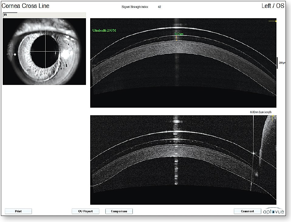Figure 9. AS-OCT of a vaulting hybrid contact lens central measurement.