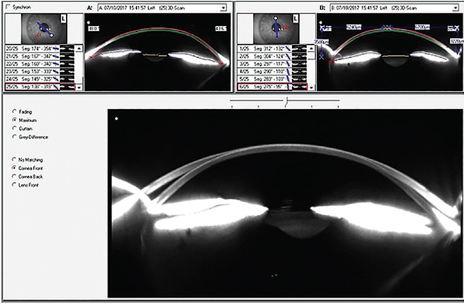 Figure 4. Scheimpflug images showing dramatic curvature difference in two meridians.