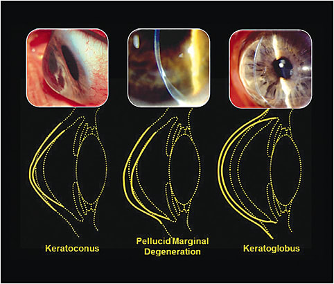 Figure 1. Common forms of acquired asymmetric and irregular astigmatism.