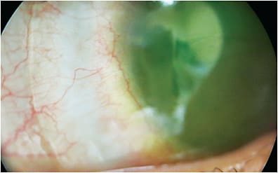 Figure 3. Blanching in the inner area of the landing zone indicating a too-flat curvature in that region. 
Image courtesy of Karen Lee