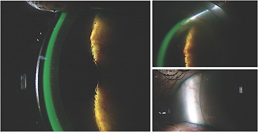 Figure 1. Filling the bowl of the lens with fluorescein and painting lissamine green on the surface of the lens on-eye can provide information on lens vault, centration, edge clearance/leakage, and conjunctival staining simultaneously.