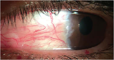 Figure 2. Patient who has a significant pterygium.