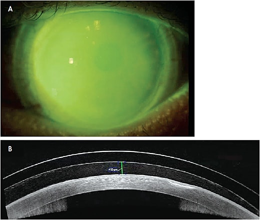 Figure 2. A patient who has PED secondary to NK fit with a scleral lens. AS-OCT demonstrates healing of PED after one week of lens wear.