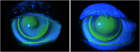 Figures 1 and 2. Different stages of keratoconus.