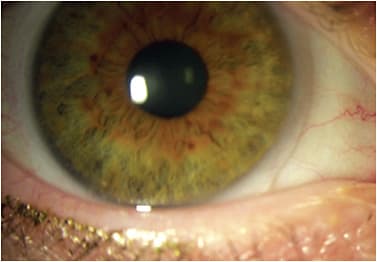 Figure 1. Lens showing subtle edge stand-off.