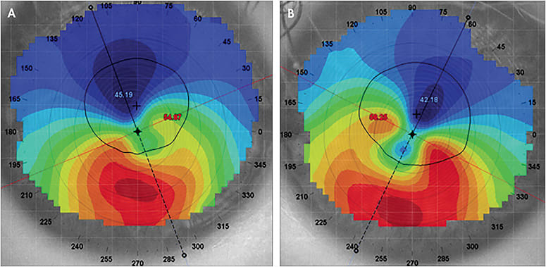 Figure 3. Topography of the right (A) and left (B) eyes of the patient in Case 6.
