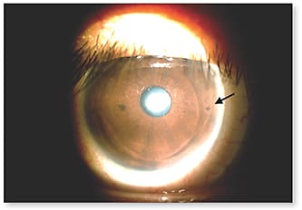 Figure 6. Custom-made soft toric multifocal lenses correct residual and high astigmatism in presbyopes. The toric markers (arrows at 3 o’clock and 9 o’clock) in the periphery of the lens designate the stability of astigmatism correction.