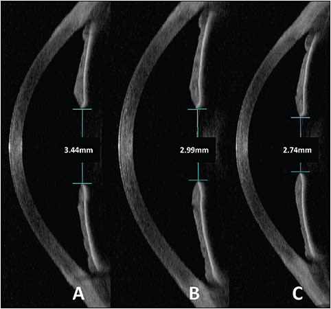 Figure 1. Optical coherence tomography images comparing pupil size in the same patient under three different testing illuminations: A) 0 lux = 3.44mm, B) 238 lux = 2.99mm, C) 605 lux = 2.74mm.