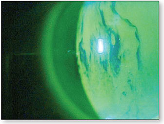 Figure 1. Evident tear film breakup pattern three seconds after the eye blinked.