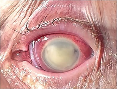 Treatment for the patient included an amniotic membrane for the epithelial defect. COURTESY MORGAN MORELLI, MD