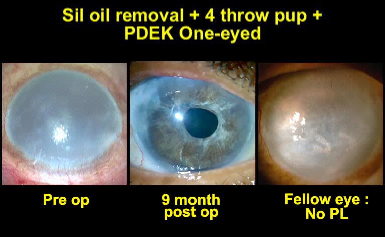 Figure 6: A. Preoperative image showing bullous keratopathy following silicone oil in a vitrectomized eye and B. Postoperative image of the same eye after combined with silicone oil removal with PDEK with pupilloplasty.