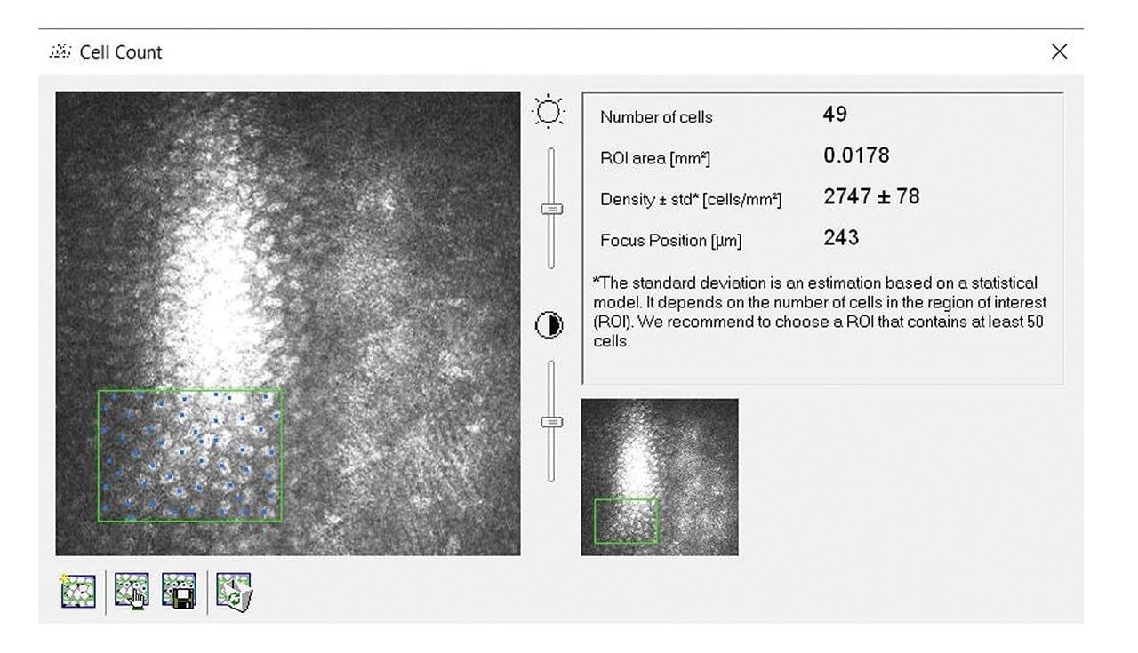 Figure 4: Endothelial cell count of animal with PVEK at 4 months (over 2,700 cells/mm2).