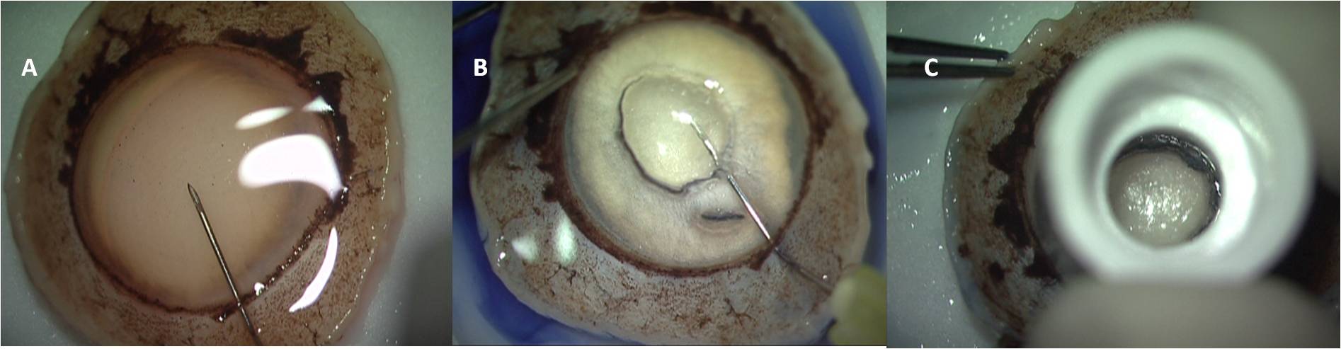 Figure 1: Pre-Descemet Endothelial Keratoplasty graft harvest from donor cornea. A: A 30-gauge needle attached to a 5 ml syringe is inserted from the limbus into the mid peripheral stroma. B: Air is slowly injected into the donor stroma for type 1 big bubble formation. C: A trephine of size of the formed bubble is used to mark along the margin of the big bubble.