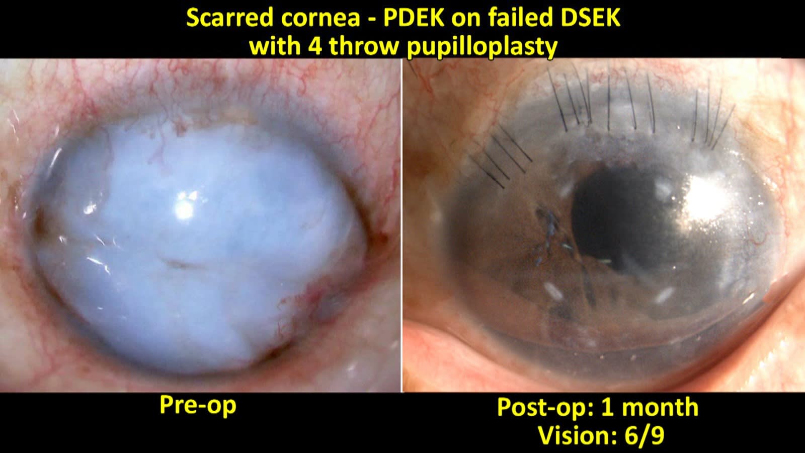 Figure 7: PDEK on failed Descemet’s membrane stripping endothelial keratoplasty graft eye. A. Preoperative and B. Postoperative image