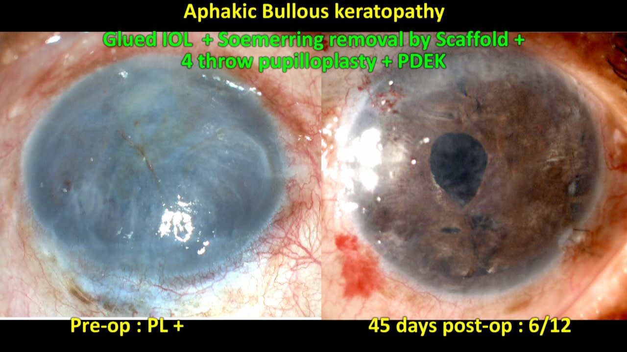 Figure 4: A. Preoperative aphakic bullous keratopathy and B. Postoperative image after combined Soemmerring removal, glued IOL with PDEK and pupilloplasty procedure.