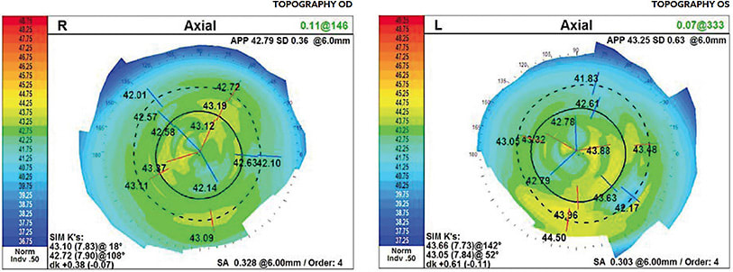 OPD III axial map demonstrating an unstable tear film.