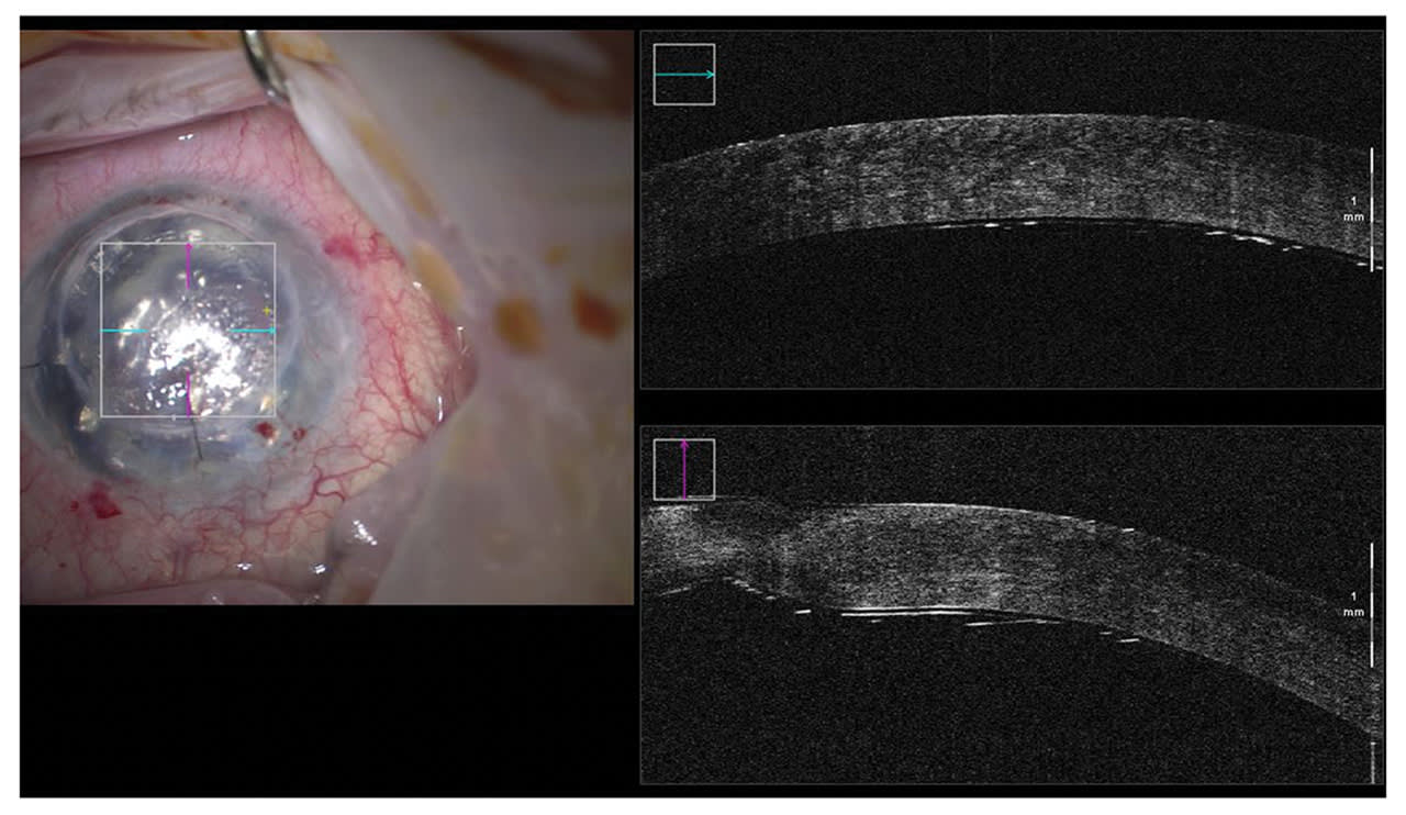 Figure 2: Perioperative OCT scanning of the artificial endothelium in situ.