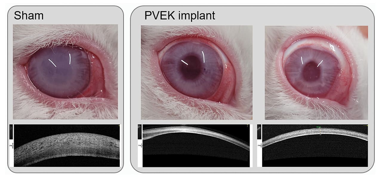 Figure 1: An example of a control rabbit that underwent descemetorhexis only (left) that developed a thick and scarred cornea at 4 weeks versus two rabbits implanted with the PVEK tissue. At 4 weeks they have a compact and transparent cornea. The AS-OCT below the color photos shows how compact they are compared to the control animal.