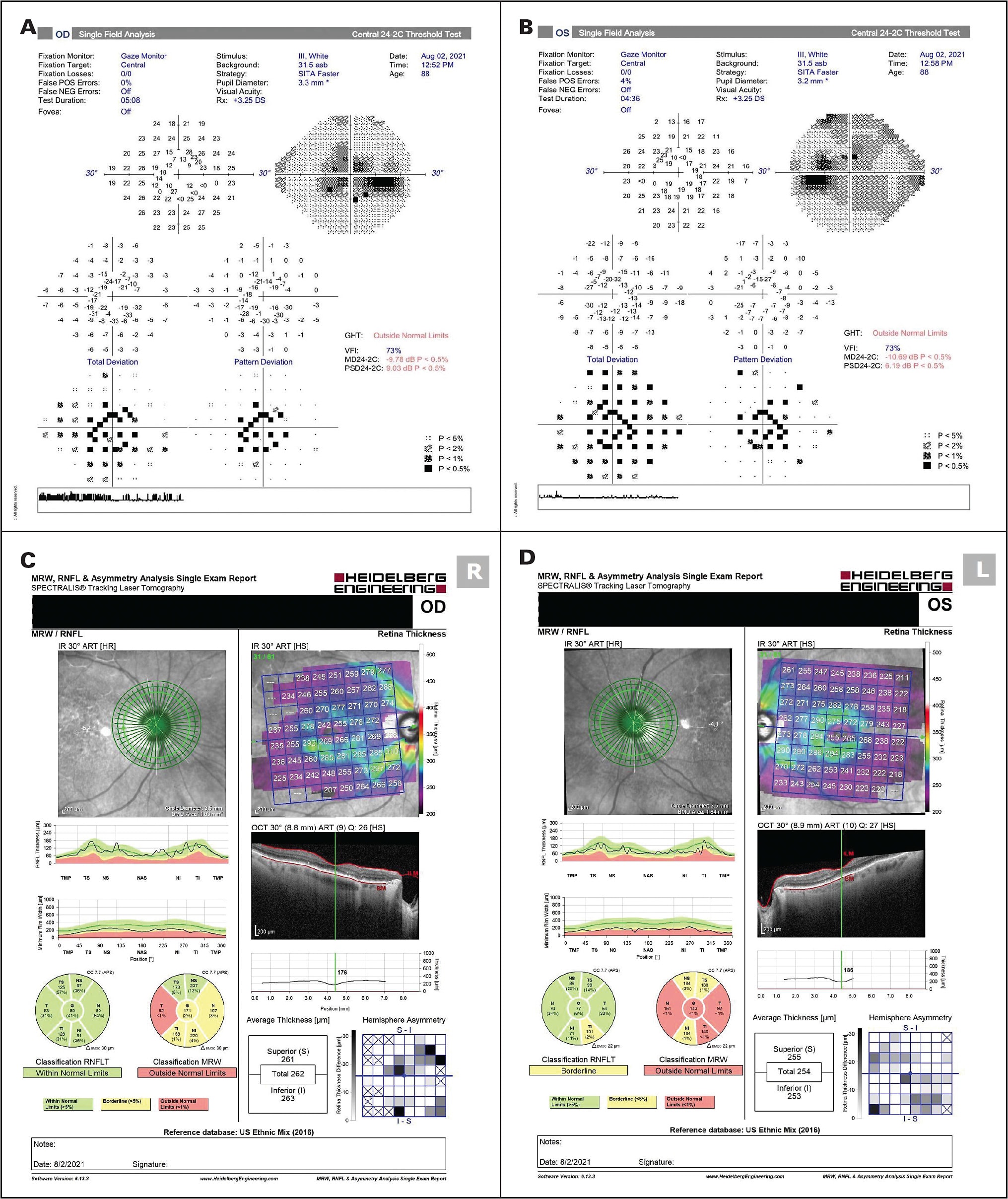 Figure 1. An 88-year-old female patient with severe ocular surface disease and mild glaucoma presented with cup-to-disc ratios of 0.75 in both eyes and intraocular pressure of 19 mmHg in the right eye and 21 mmHg in the left eye, on 3 different topical glaucoma medications. Humphrey visual field testing showed diffuse depression on total deviation plots with paracentral scotomas on pattern deviation in both eyes (A, B). Optical coherence tomography showed a full retinal nerve fiber layer in the right eye with early inferior retinal nerve fiber layer changes in the left eye (C, D).