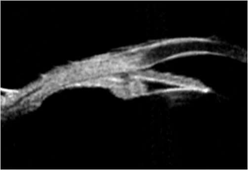Figure 1. Preoperative ultrasound biomicroscopy showing narrow angle, shallow anterior chamber, and large, anteriorly rotated ciliary processes with iris contact.