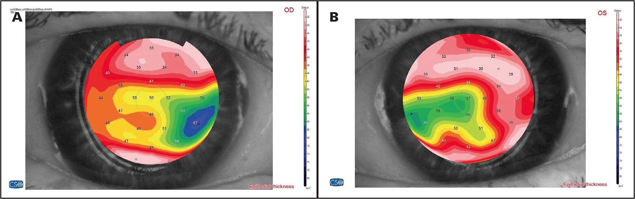 Figure 2. Epithelial cell mapping of the patient’s right (A) and left (B) eyes showing diffuse epithelial thickness irregularity, consistent with the patient’s ocular surface disease and epithelial basement membrane dystrophy.