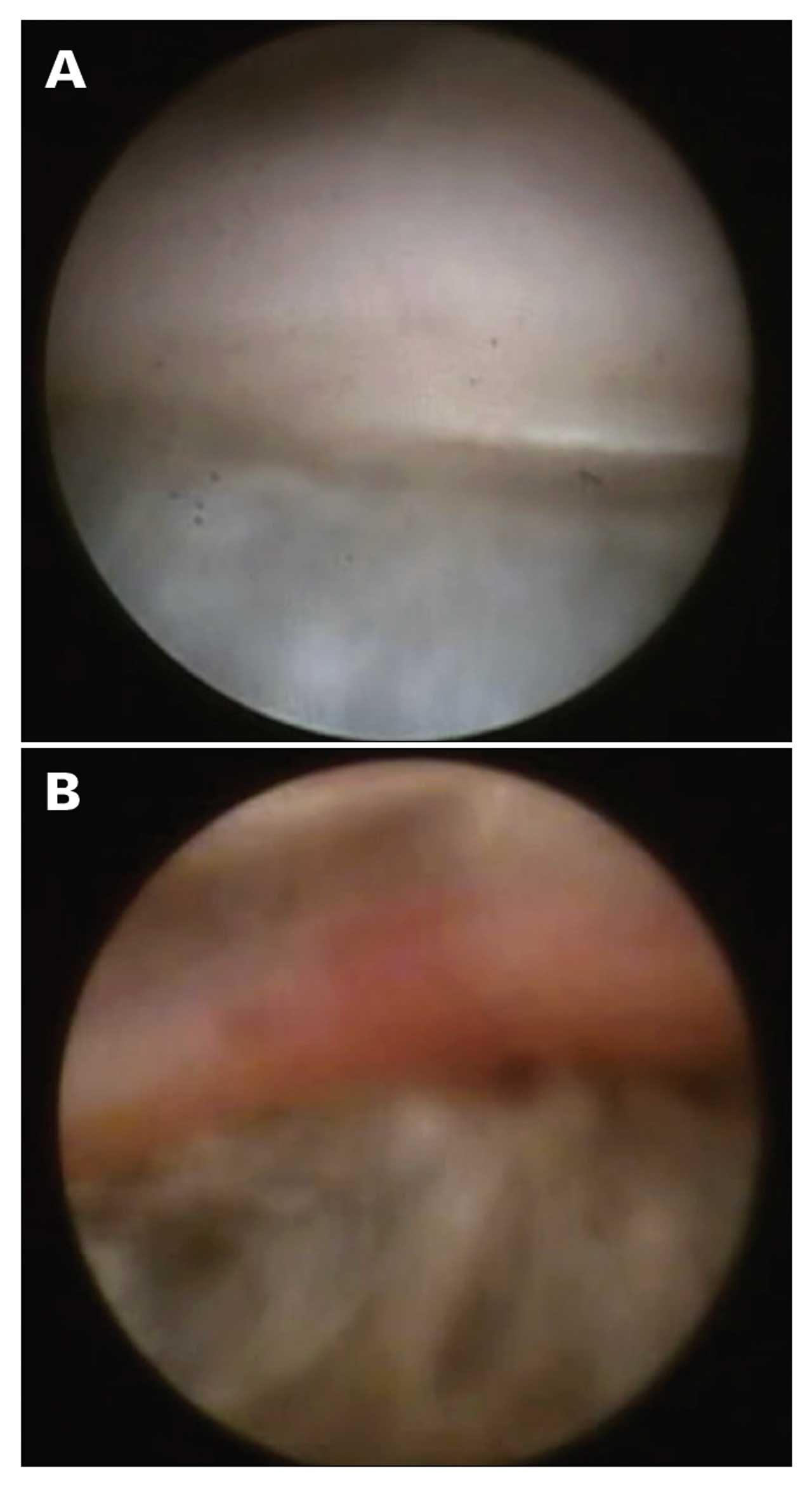 <p><strong>Figure 7. </strong>Intraoperative endoscopic view of the angle and a traumatic cyclodialysis cleft (A) and the same angle after surgical closure using indirect cyclopexy (B).</p>
