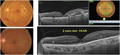 FIGURE 1: DME resolved on lipid panel control only. No other forms of local eye treatment were attempted.COURTESY OF PROF. DR. MAGDY MOUSSA, MD, PhD.
