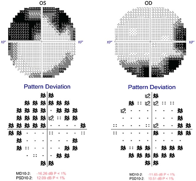 FIGURE 1: HVF 10-2 shows visual field loss involving both central fields. IMAGE COURTESY WEI CHEN LAI, BS