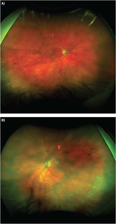 FIGURE 2. (A) Widefield fundus photos of the right eye showing mild vitritis. (B) Widefield fundus photos of the left eye showing moderate vitritis.