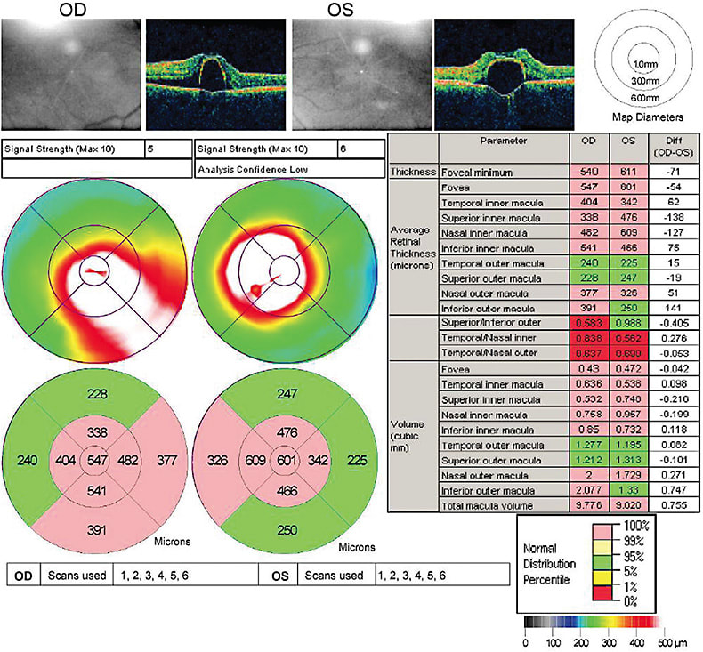 FIGURE 1: Optical coherence tomography heat maps of the 55-year-old patient’s right (OD) and left (OS) eyes depict retinal thickness at visits after periods of intense exercise and after cessation of intense exercise. This led to the hypothesis that the exercise might be the exacerbating issue, and that changing or limiting the exercise—and thus mitigating cortisol levels—could help lessen his disease burden. Note the marked improvement in the OD retinal thickness and edema. Images taken with a Zeiss Stratus OCT. IMAGE COURTESY DAVID HUNT, MD, FACS