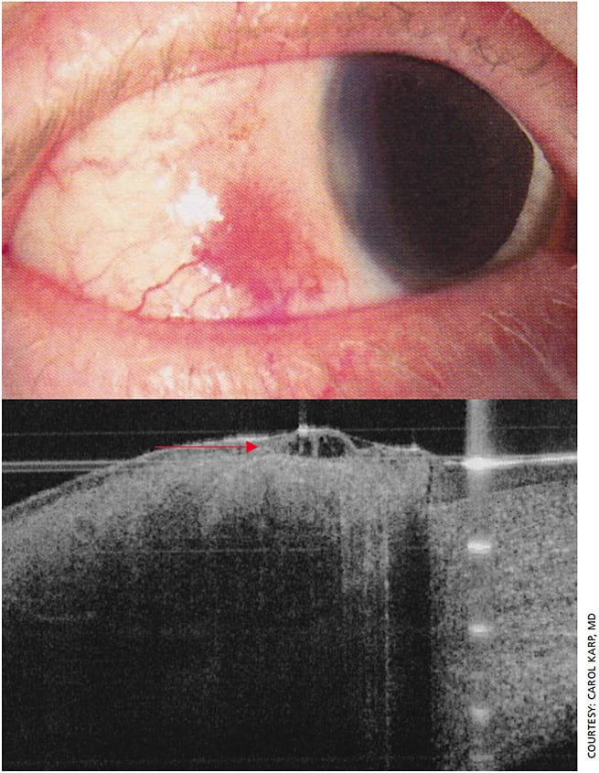 Figure 7. Slit lamp photo and anterior segment OCT of conjunctival amelanotic melanoma