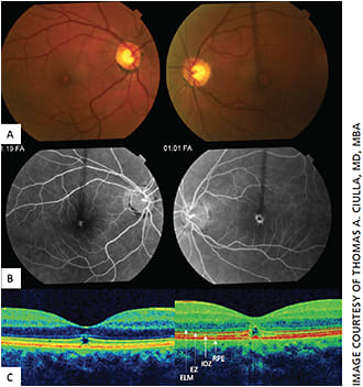 Figure 5. Ellipsoid and interdigitation zone atrophy from solar maculopathy.