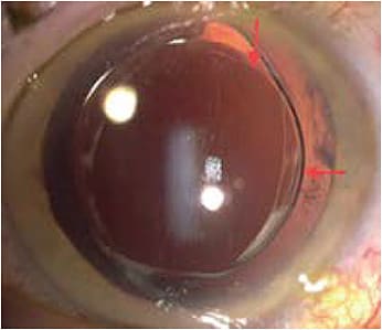 Figure 2. Secondary reverse optic capture. The optic is placed in front of the anterior capsule, and the haptics remain in the capsule bag. Haptics should be placed at 6 and 12 o’clock (superior arrow), and the optic is placed over the nasal (and temporal) anterior capsulotomy (right arrow). The capsulotomy opening should be 4.8 mm to 5.0 mm for this to be a successful strategy.